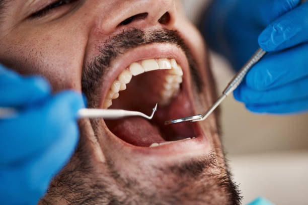 Best Emergency Tooth Extraction in Spring, TX